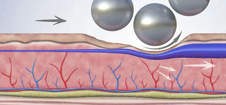 Lymphatic drainage and removal of excess fluid to reduce swelling.