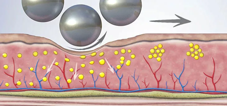 Body contouring and figure shaping with the Endospheres device.