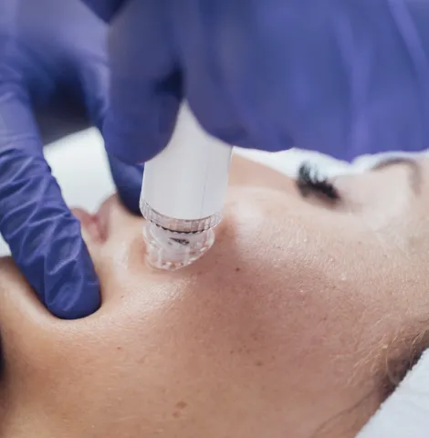 Process of using the hydrodermabrasion handpiece for deep skin cleansing.