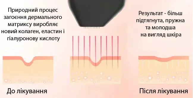 Визуализация работы INDIBA Reverso с радиочастотной энергией для обновления клеток кожи.